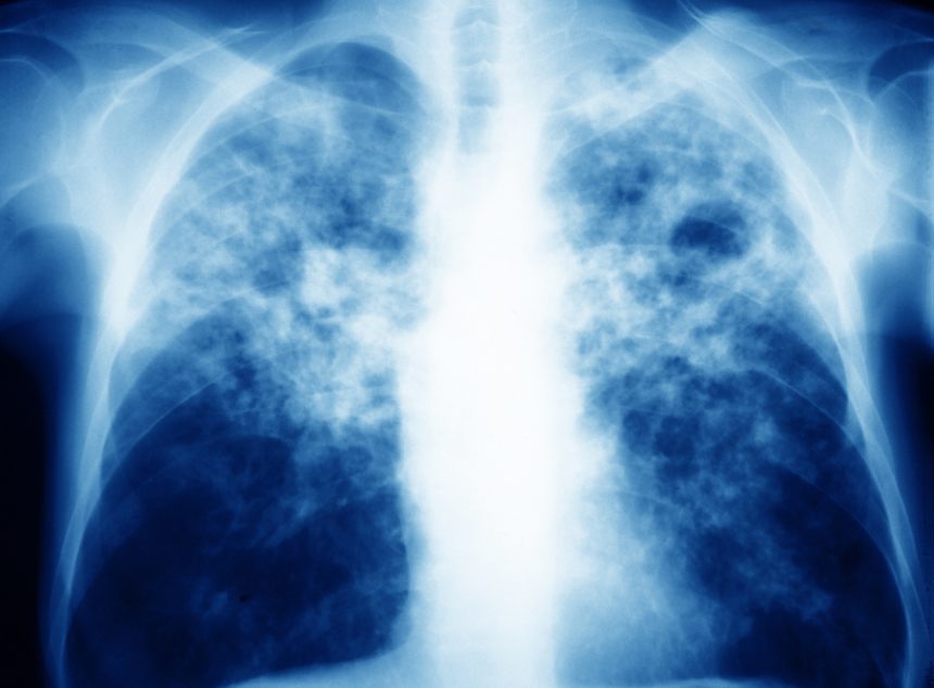  Given the recent leveling of tuberculosis incidence, correct application and reading of the tuberculin skin test is imperative.